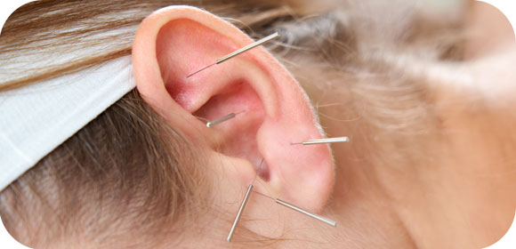 Oreille avec aiguille - auriculothérape